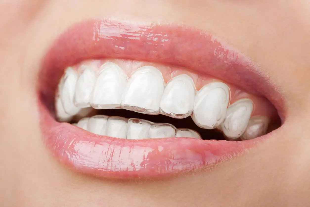 Invisalign: Mastering the Art of Smile Transformation Through Subtle Design